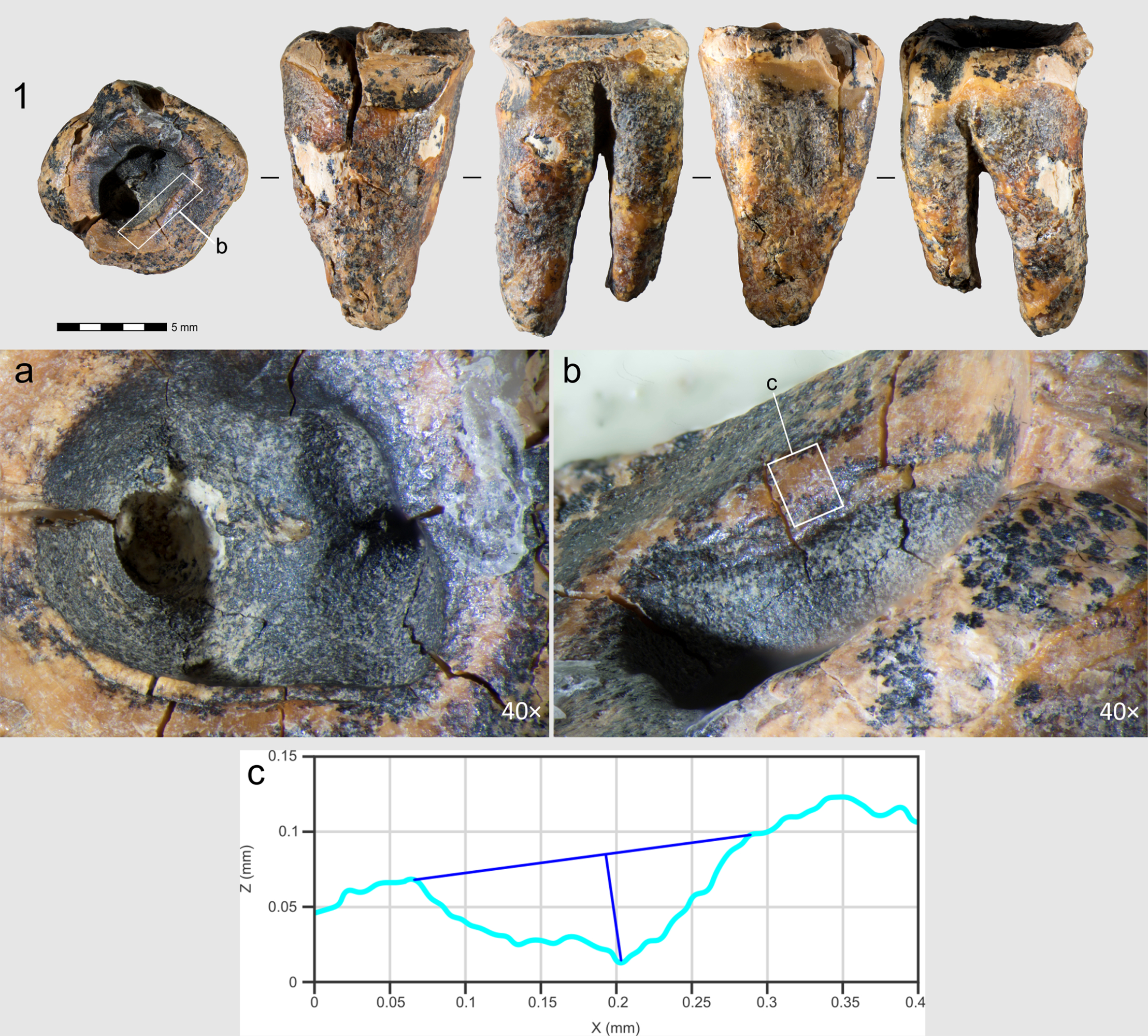 ¡Sorpresa Paleolítica! Descubren en Siberia el Tratamiento Dental Más Antiguo del Mundo